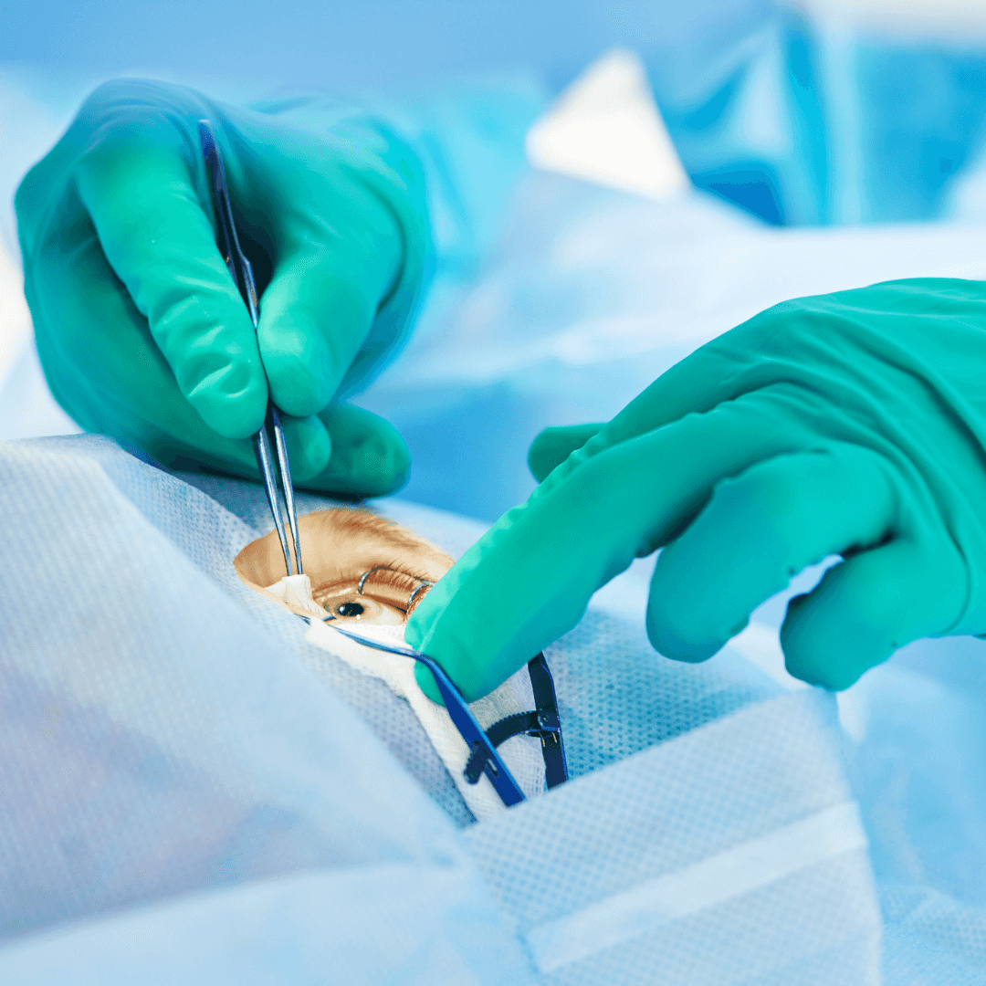 Un médico oftalmólogo con guantes verdes sostiene un par de pinzas mientras realiza un procedimiento quirúrgico en el ojo.